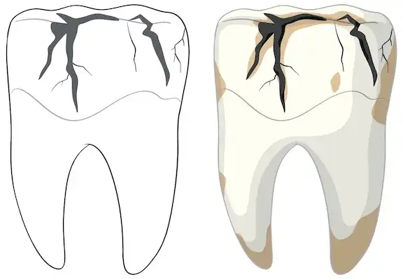 SMILES ON 35th can help with your broken or chipped tooth